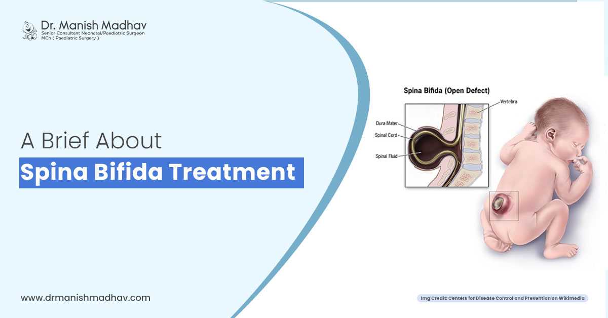 A Brief About Spina Bifida Treatment