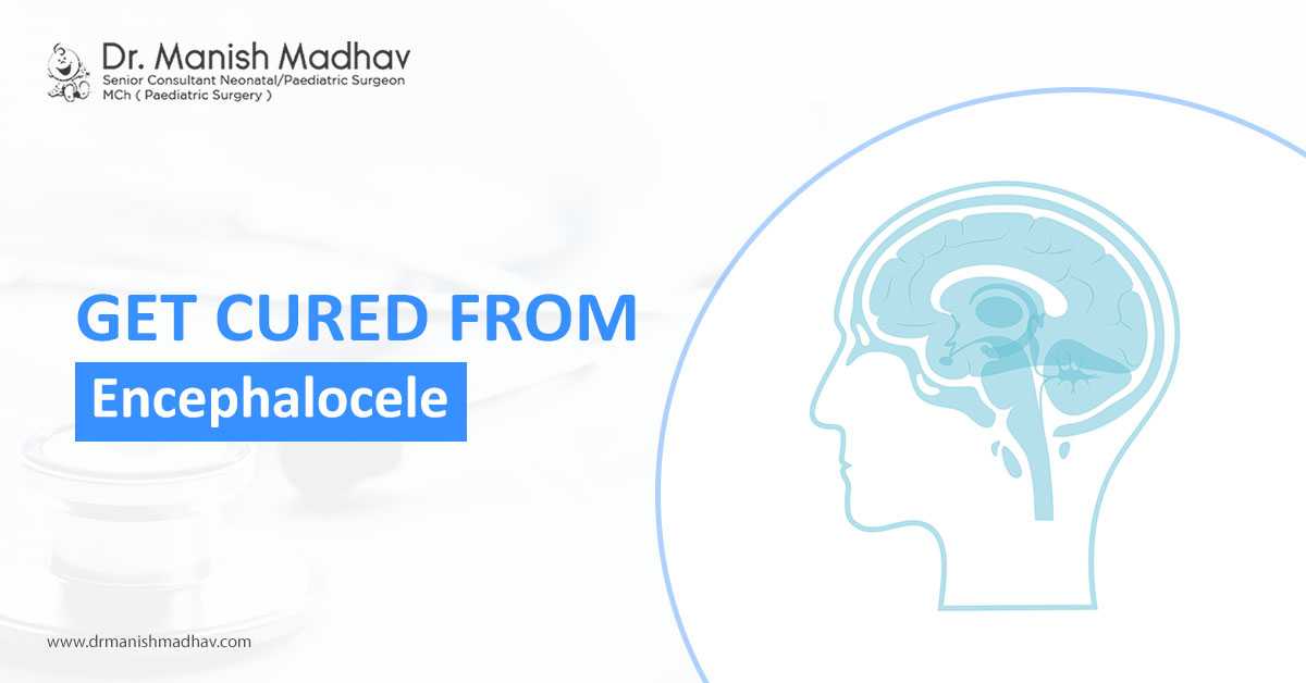 Get Cured From Encephalocele