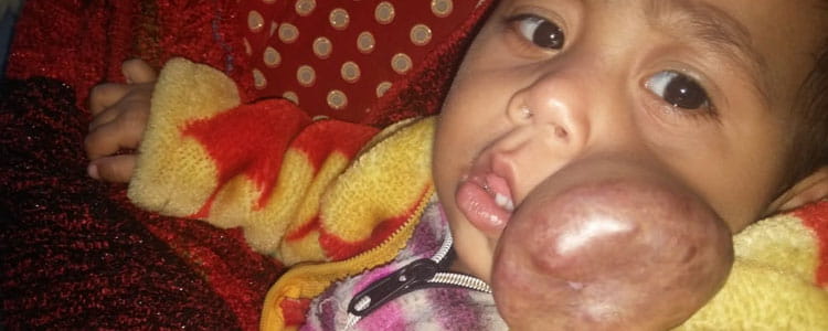 Cheek Hemangioma