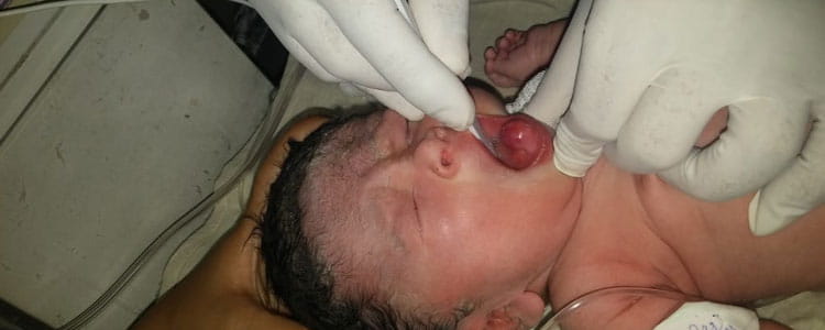 Congenital Epulis