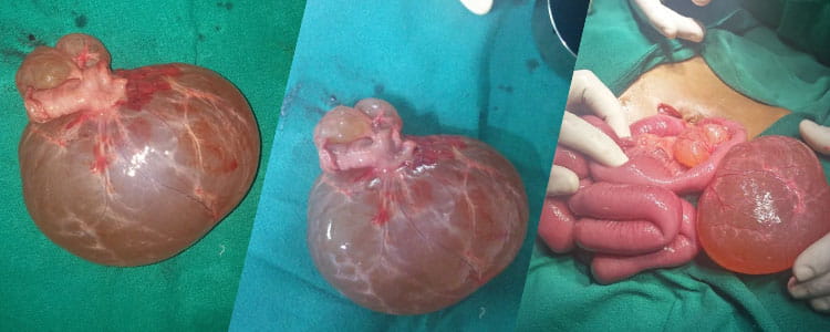 Enteric Duplication Cyst