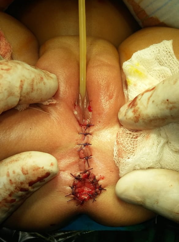 fistula surgery ASARP 
