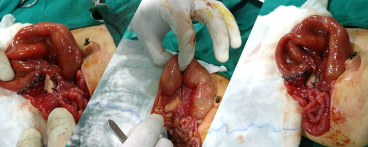 Ileal Atresia