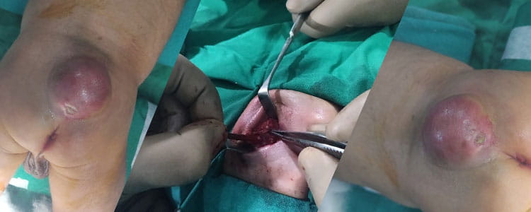 Lumbosacral Meningomyelocoele 