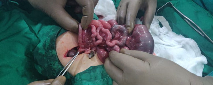 Meconium Ileus