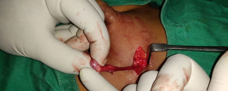 Orchidopexy   for  Undescended Testis