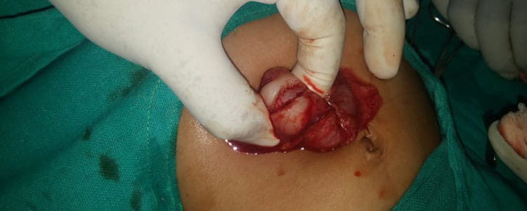 Pyloric Stenosis