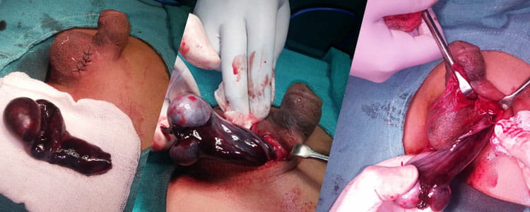 Torsion testis