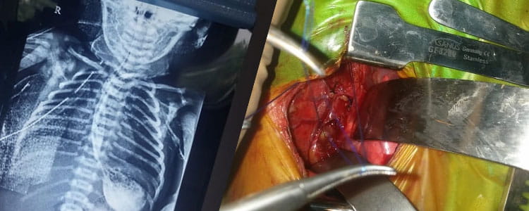 Tracheo Oesophageal Fistula