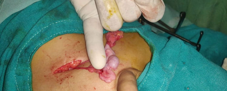 Undescended Testis 