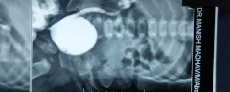 Vesico Ureteric Reflux